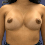 Breast Augmentation 17 After
