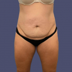 Abdominoplasty (Tummy Tuck) 12 Before