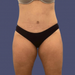 Abdominoplasty (Tummy Tuck) 10 After