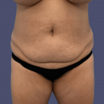 Abdominoplasty (Tummy Tuck) 9 Before