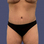 Abdominoplasty (Tummy Tuck) 11 After