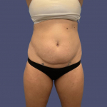 Abdominoplasty (Tummy Tuck) 15 Before