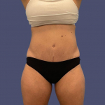 Abdominoplasty (Tummy Tuck) 14 After