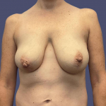 Breast Reduction 8 Before