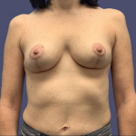 Breast Reduction 8 After
