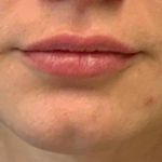 Lip Filler 8 Before
