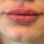 Lip Filler 8 After