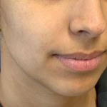 Dermal Filler 1 - Chin and Jawline Before
