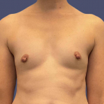 Breast Augmentation 35 Before