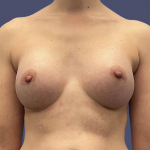 Breast Augmentation 35 After