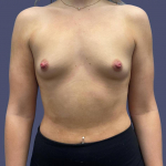 Breast Augmentation 28 Before