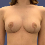 Breast Reduction 3 After