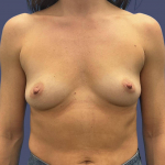 Breast Augmentation 38 Before