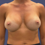 Breast Augmentation 38 After
