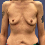Breast Augmentation 19 Before