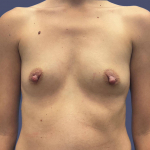 Breast Augmentation 22 Before