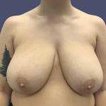 Breast Reduction 4 Before
