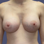 Breast Augmentation 25 After