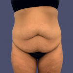 Abdominoplasty (Tummy Tuck) 1 Before