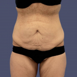 Abdominoplasty (Tummy Tuck) 17 Before