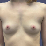 Breast Augmentation 14 Before