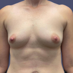 Breast Augmentation 39 Before