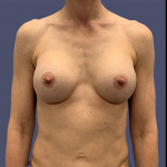 Breast Augmentation 16 After