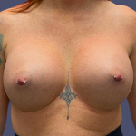 Breast Augmentation 28 After