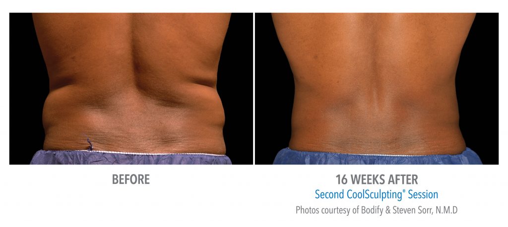 CoolSculpting after 16 weeks