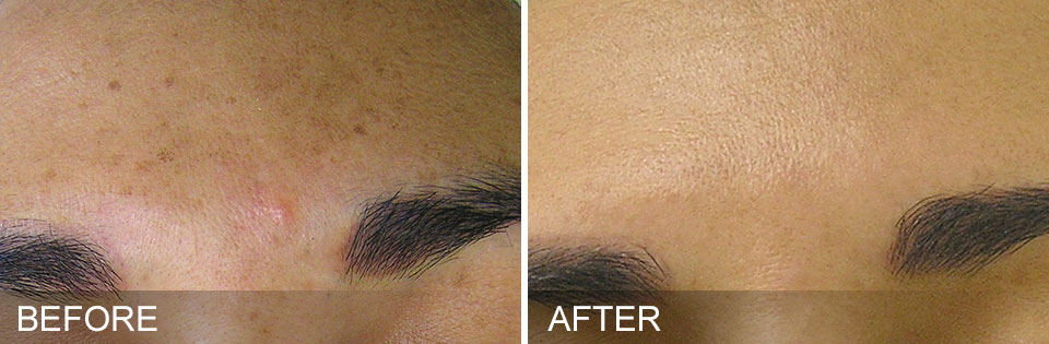 age spots before-after