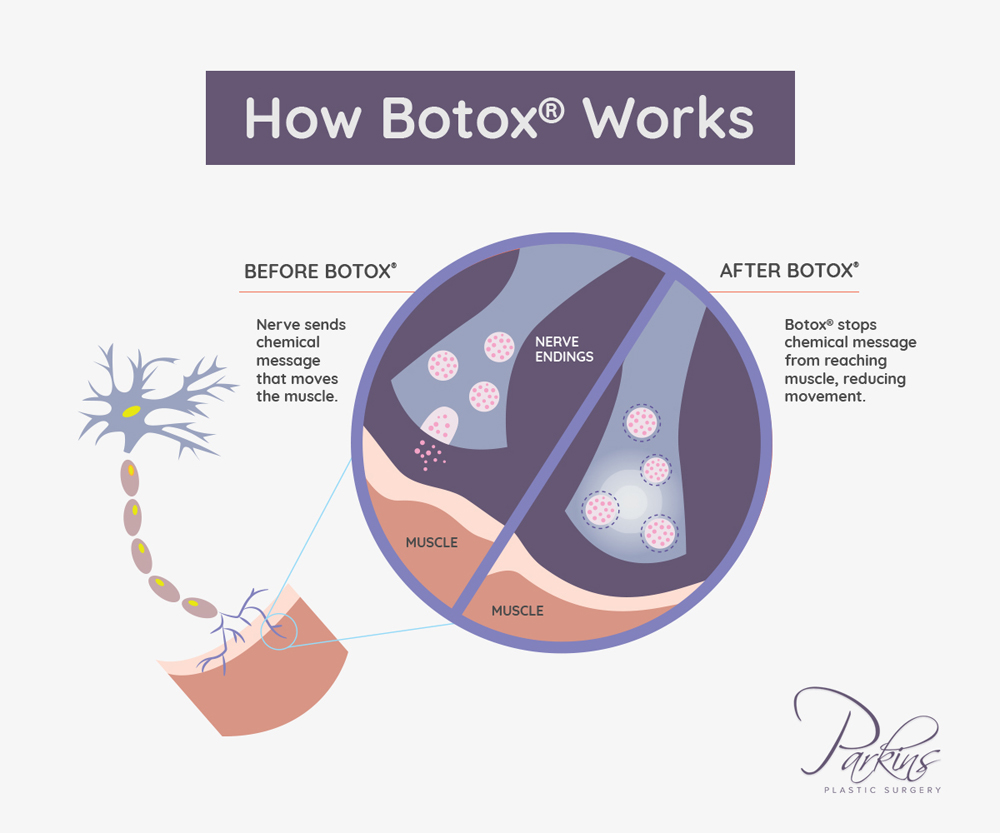 Relax active muscles that cause facial wrinkles with BOTOX® at the Milwaukee area's Parkins Plastic Surgery. Relax active muscles that cause facial wrinkles with BOTOX® at the Milwaukee area's Parkins Plastic Surgery.