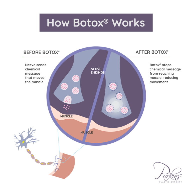 Relax active muscles that cause facial wrinkles with BOTOX® at the Milwaukee area's Parkins Plastic Surgery. Relax active muscles that cause facial wrinkles with BOTOX® at the Milwaukee area's Parkins Plastic Surgery.