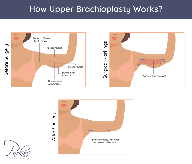 Discover what’s involved in an arm lift or brachioplasty in the Milwaukee area. Discover what’s involved in an arm lift or brachioplasty in the Milwaukee area.