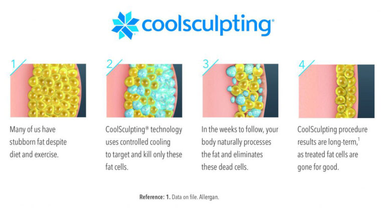 CoolSculpting technology targets and kills fat cells, allowing the body to dispose of them naturally.