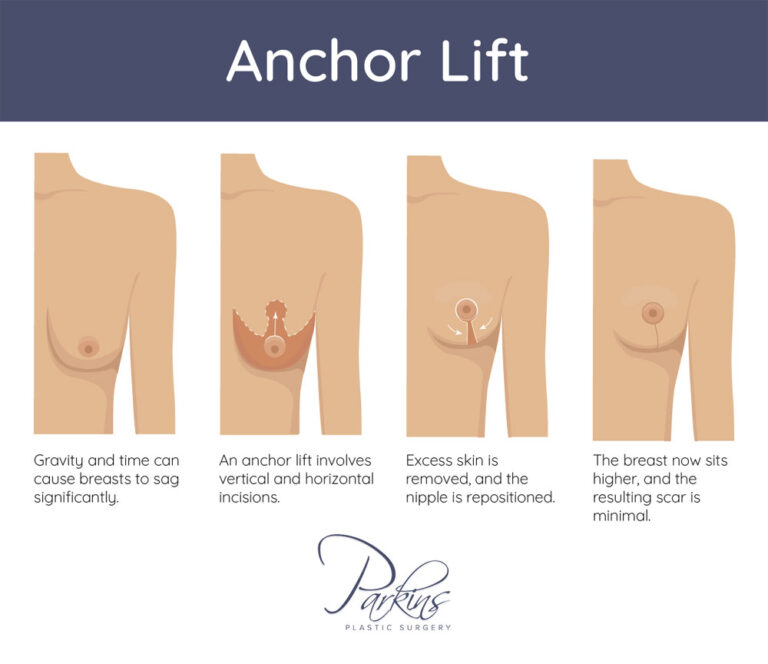 Discover what goes into an 'anchor'-style breast lift at the Milwaukee area's Parkins Plastic Surgery.