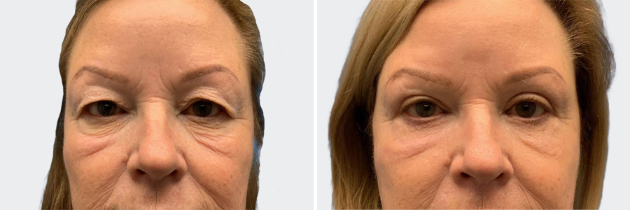 Blepharoplasty