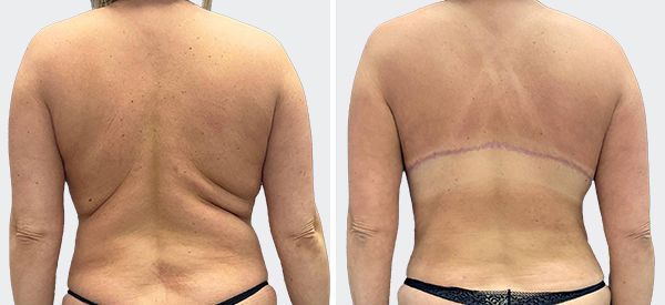 Bra Line Back Lift™ Before & After Photos