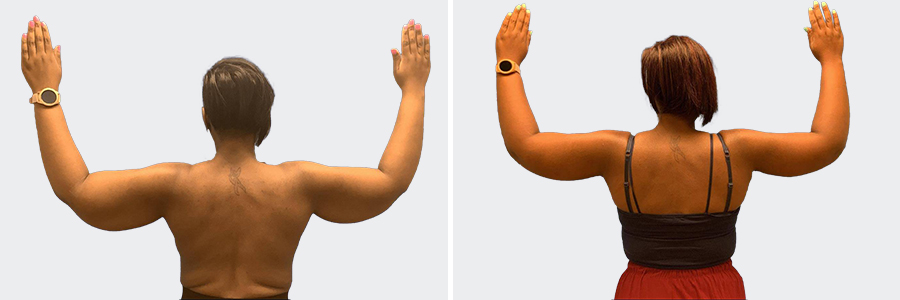 Arm Lift Before After