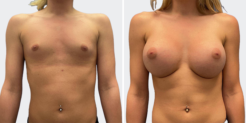 Breast Augmentation Before After