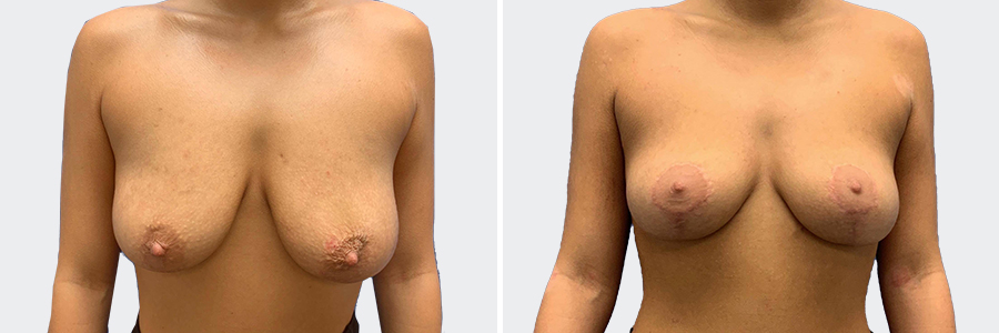 Breast Lift Before After