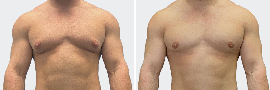 Male breast Reduction