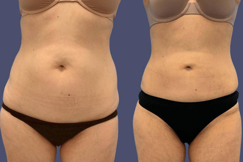 Liposuction Before After