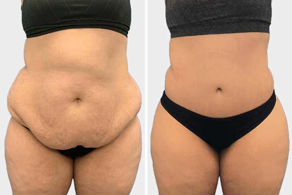 Tummy Tuck Before After