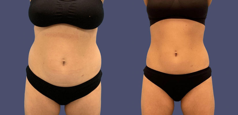 Coolsculpting Before After