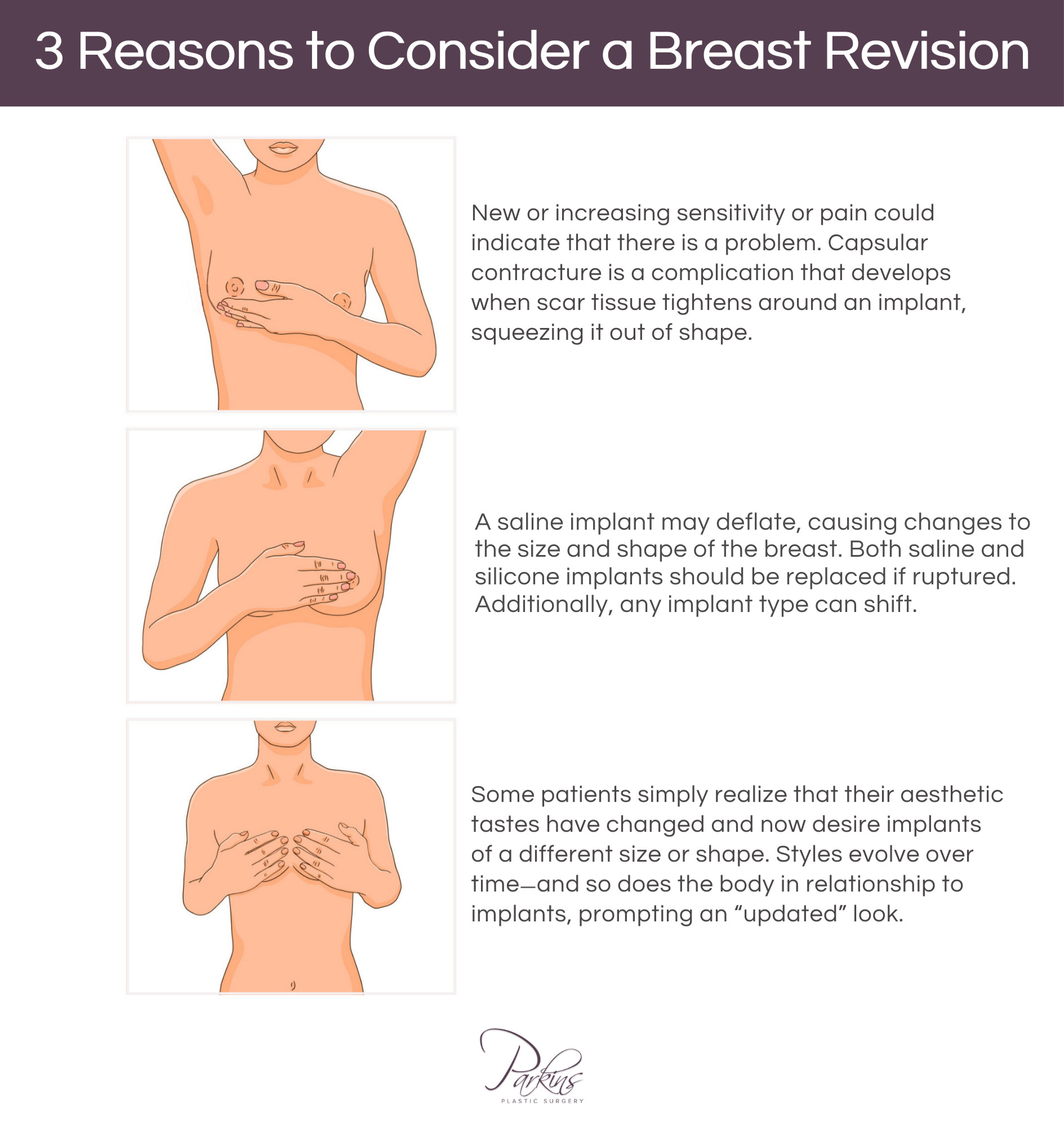 How long do breast implants last?