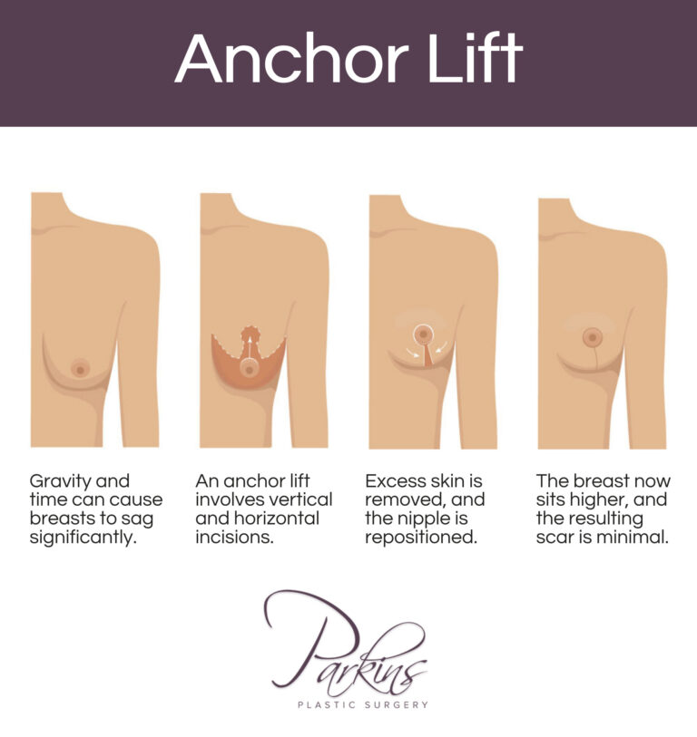 What to Expect During and After Breast Lift Surgery