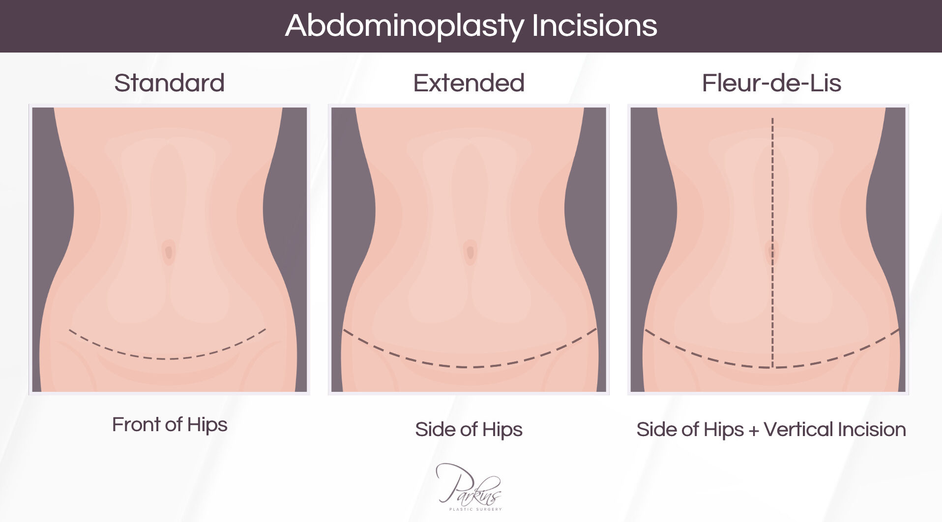 Tummy Tuck (Abdominoplasty) - Parkins Plastic Surgery