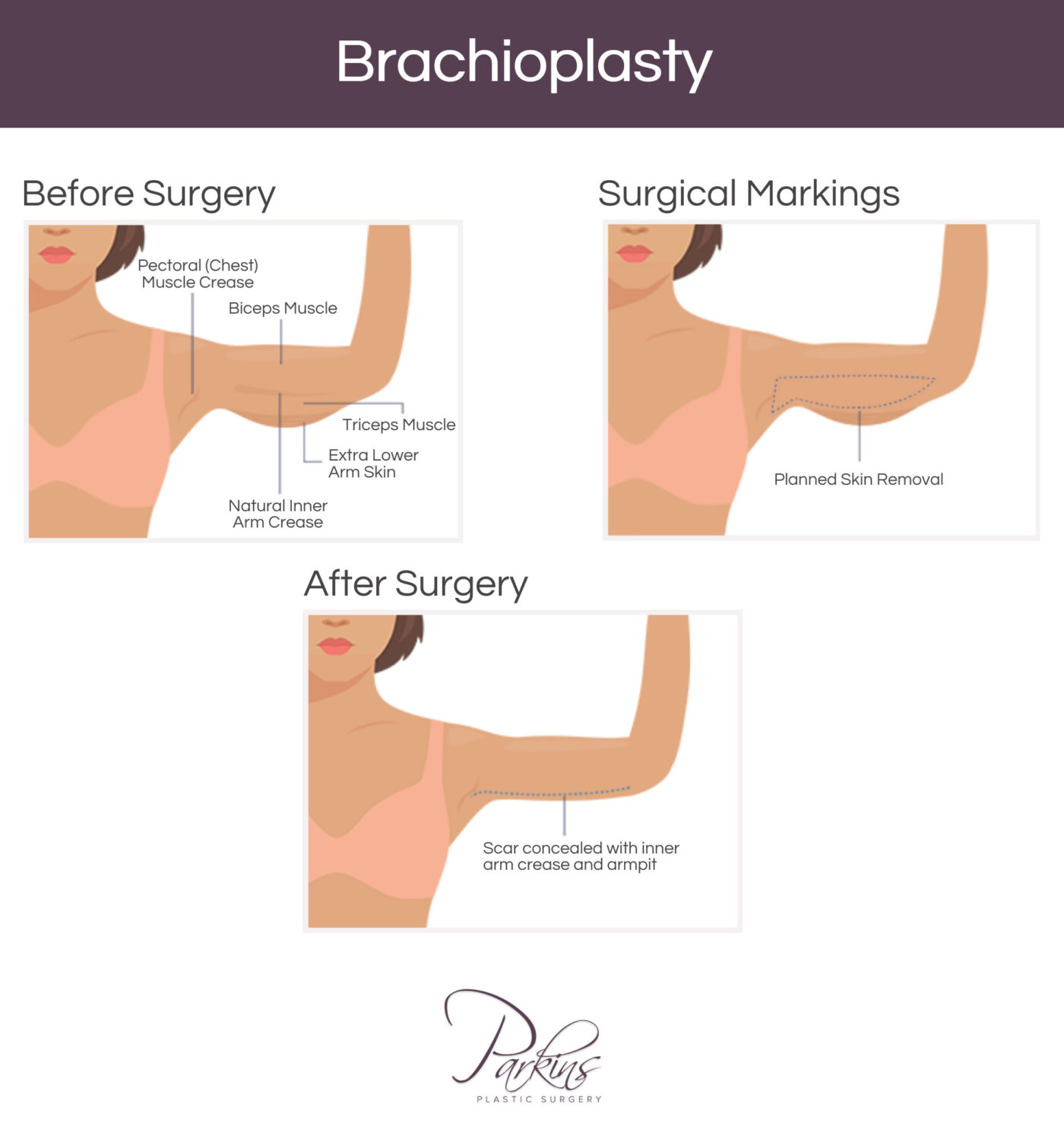 Brachioplasty-1400×1482