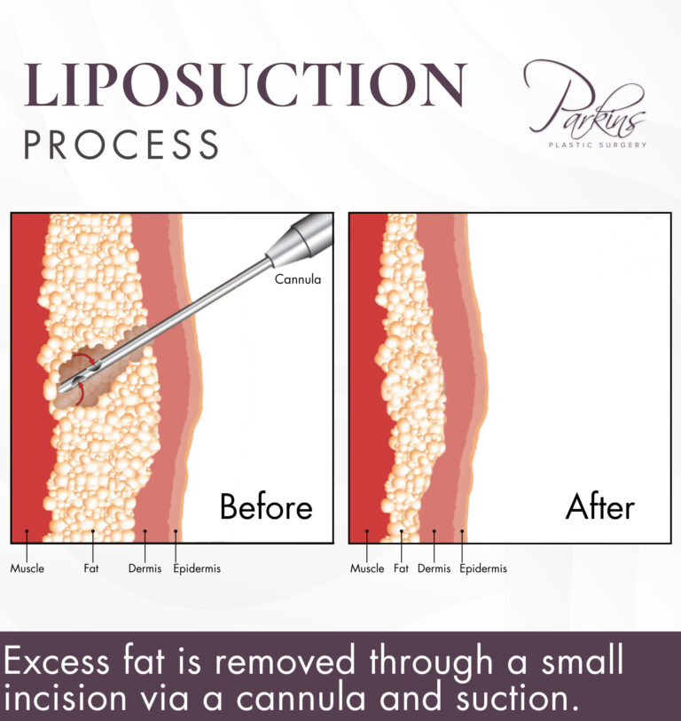 Liposuction-Process-e1704821593464-768×813