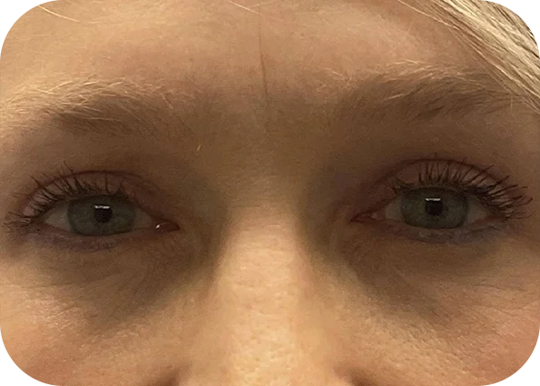 eye2